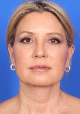 Case # 1 after photo