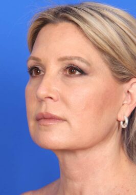 Case # 1 after photo