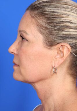 Case # 1 before photo