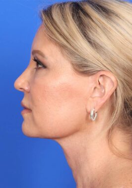 Case # 1 after photo