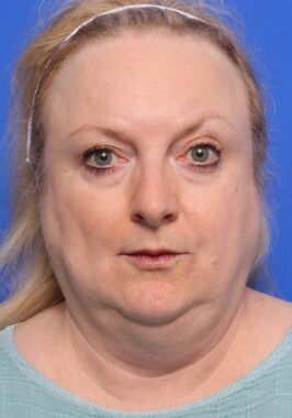 Case # 30 before photo