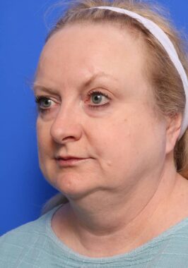 Case # 30 before photo