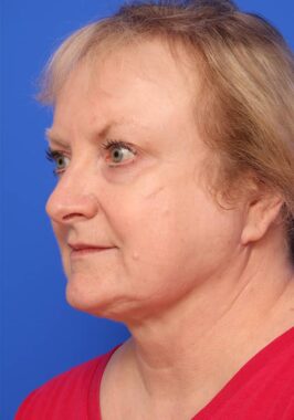 Case # 30 after photo