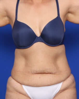 Case # 52 before photo