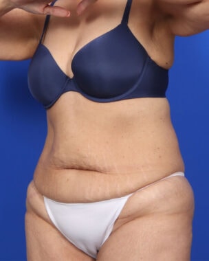 Case # 52 before photo