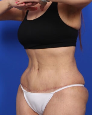 Case # 52 after photo