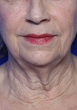 Case # 32 before photo