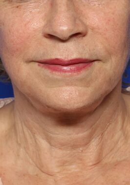 Case # 32 after photo