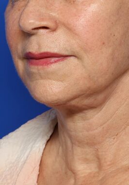 Case # 32 after photo