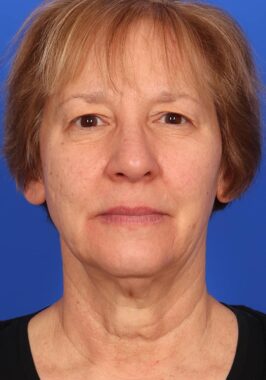 Case # 33 before photo