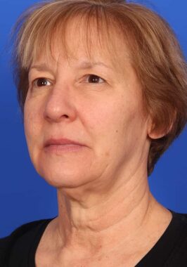 Case # 33 before photo