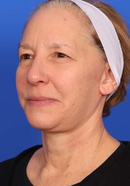 Case # 33 after photo