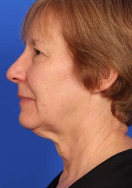 Case # 33 before photo