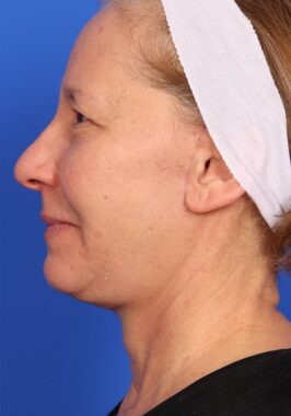 Case # 33 after photo