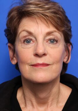 Case # 31 after photo