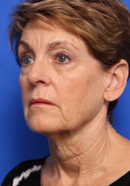 Case # 31 before photo