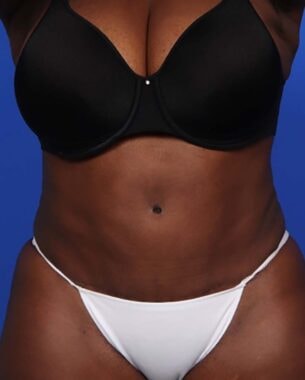 Case # 23 after photo