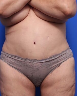 Case # 26 after photo