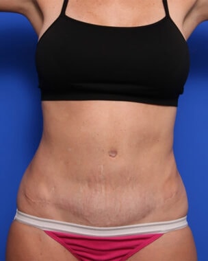 Case # 28 after photo