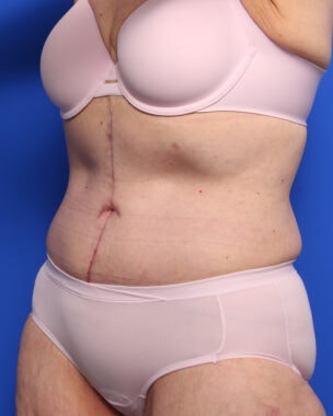 Case # 29 after photo