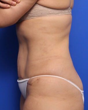 Case # 30 after photo