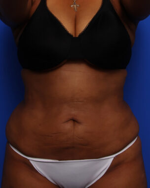 Case # 9 after photo