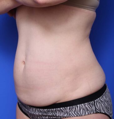 Case # 5 after photo