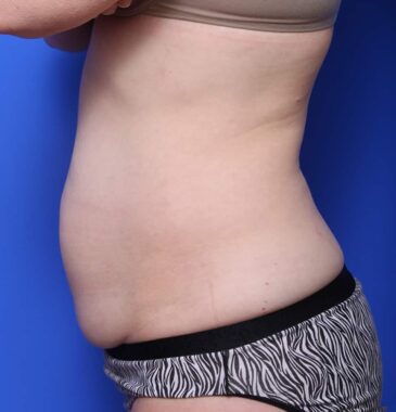 Case # 5 after photo