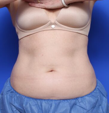 Case # 10 before photo