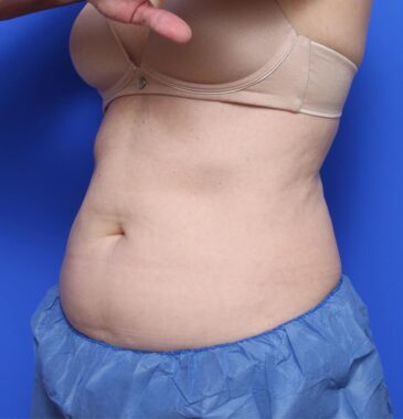 Case # 10 before photo