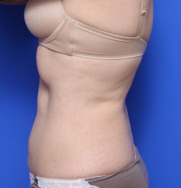 Case # 10 after photo