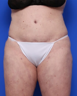 Case # 35 after photo