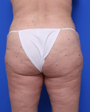 Case # 35 after photo