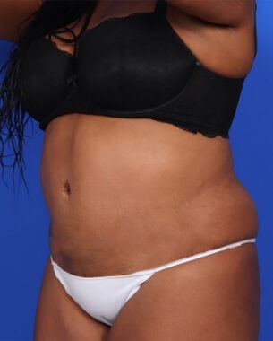 Case # 37 after photo