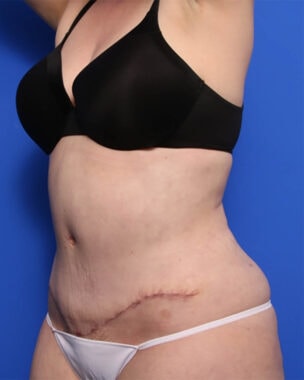 Case # 3 after photo