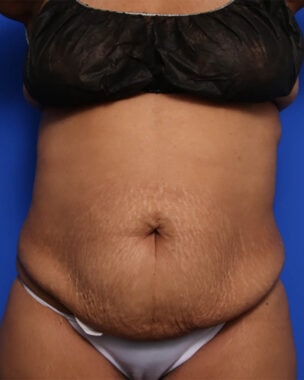 Case # 38 before photo