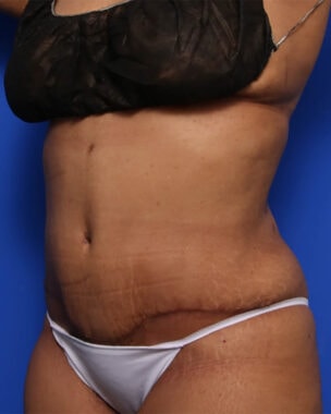 Case # 38 after photo