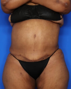 Case # 41 after photo