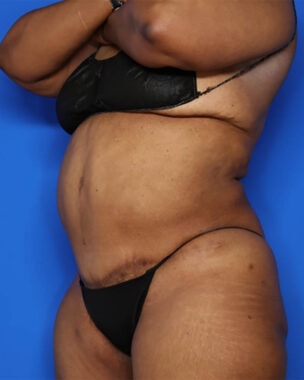 Case # 41 after photo