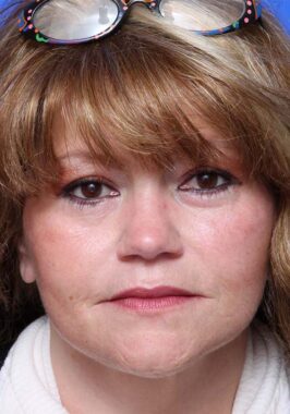 Case # 34 after photo