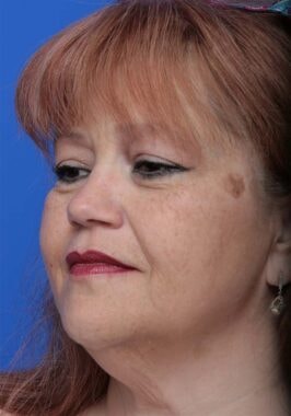 Case # 34 before photo