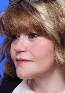 Case # 34 after photo