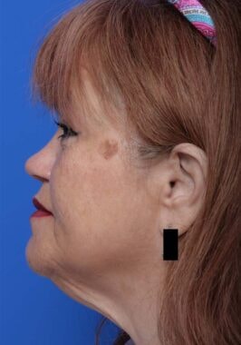 Case # 34 before photo