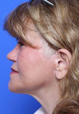 Case # 34 after photo