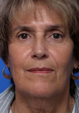 Case # 35 before photo