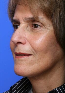 Case # 35 after photo