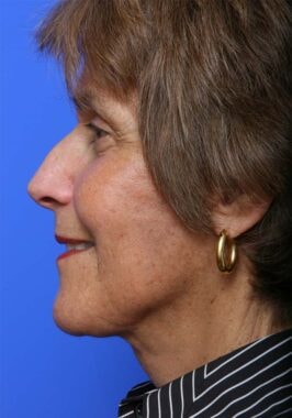 Case # 35 after photo