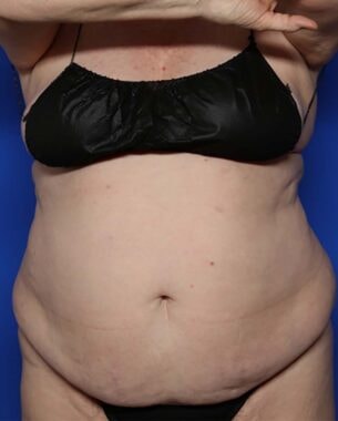 Case # 14 before photo