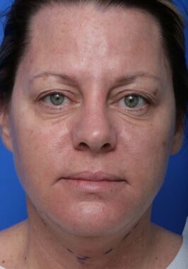 Case # 3 before photo