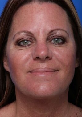 Case # 3 after photo